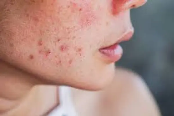 Comment traiter l’acné de façon naturelle