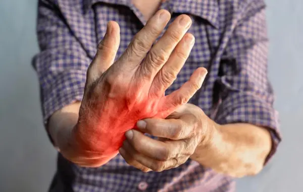La polyarthrite rhumatoïde : soulager les symptômes